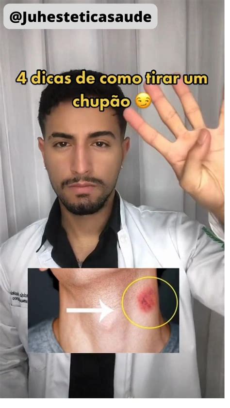 chupão no peito|Como Se Livrar de Um Chupão Da Noite pro Dia: 9 Passos